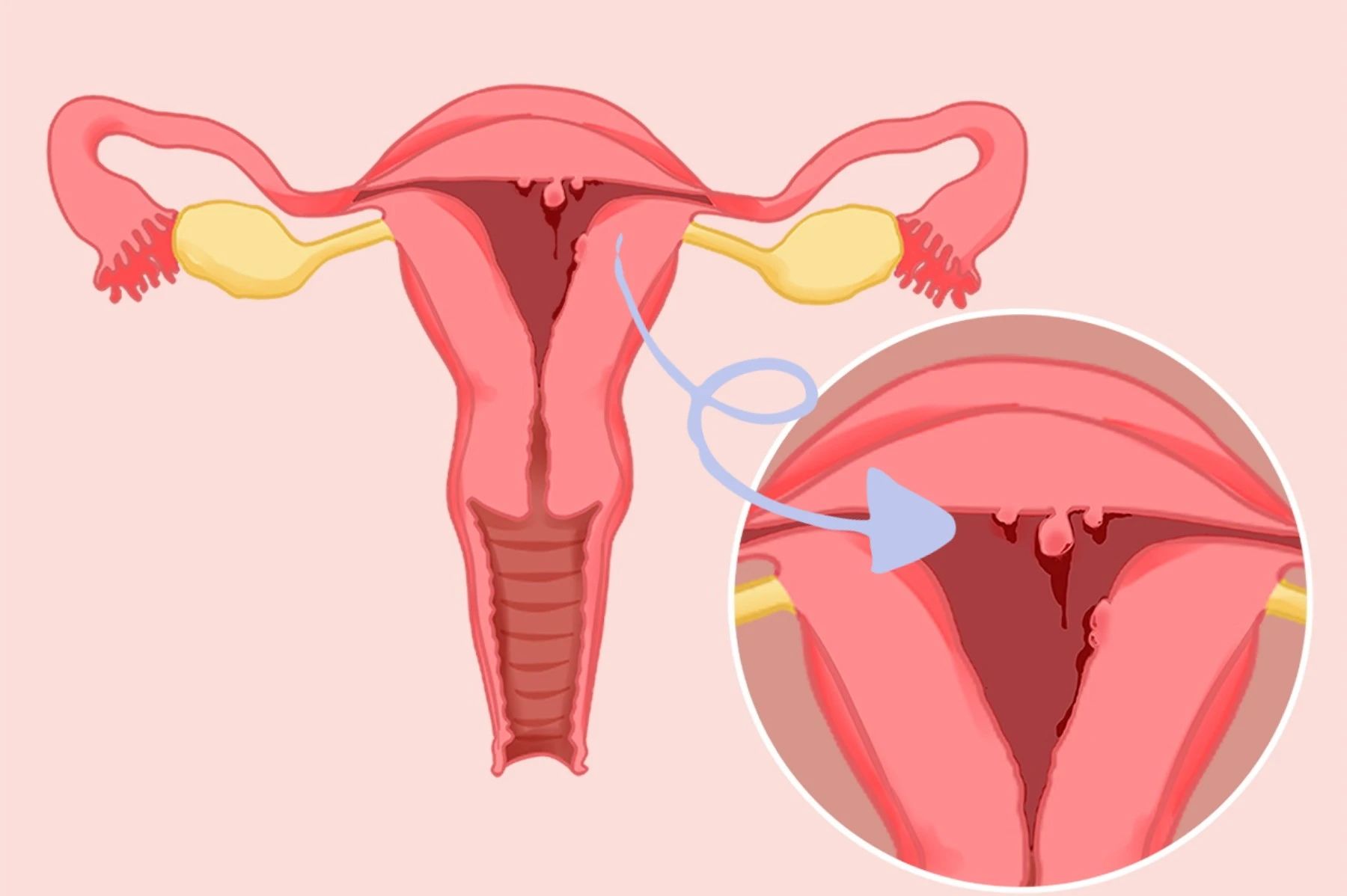 【健康科(kē)普】長(cháng)了(le)子(zǐ)宮息肉怎麽辦？不(bù)要(yào)輕視(shì)！